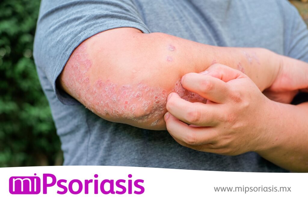 Mi Psoriasis